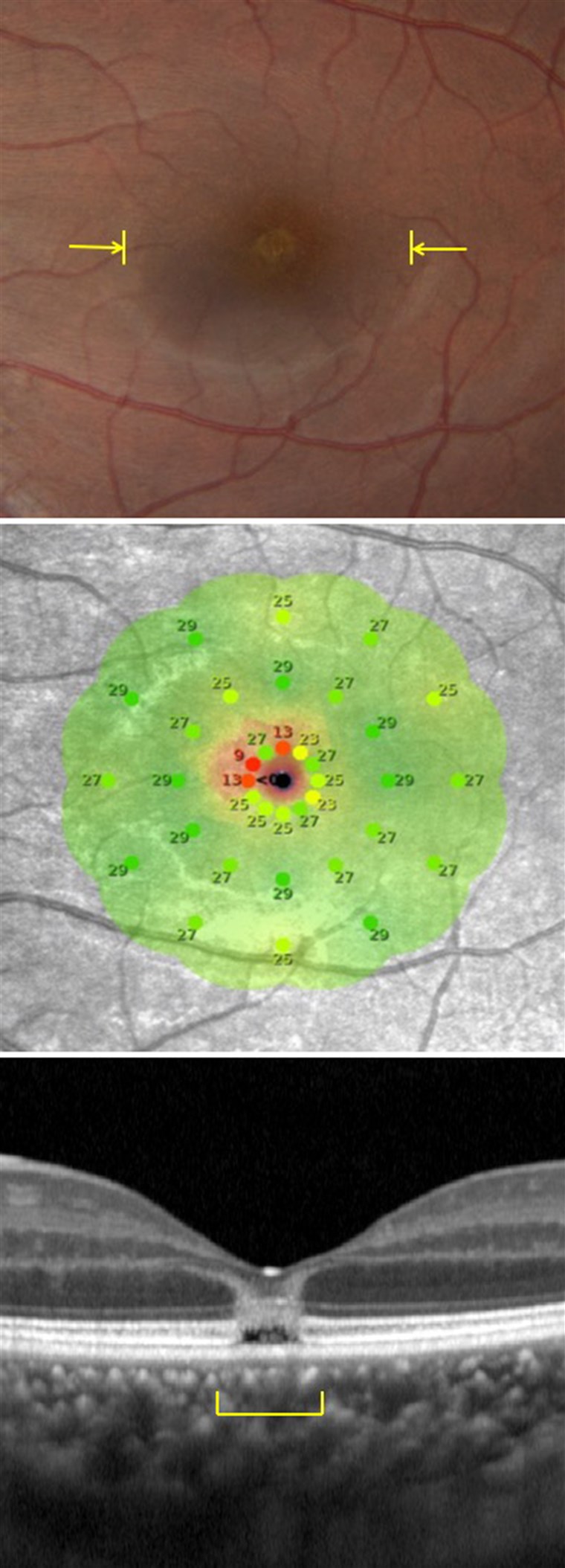 新しい technology allowed doctors to see for the first time what happens when someone experiences solar retinopathy. 