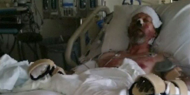 웨스트 Bend lost both hands and both lower legs to amputation to save his life.