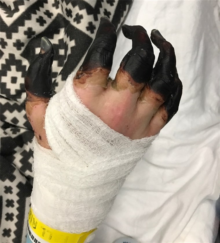 브린's hands turned black as a result of his infection and may have to be amputated. 
