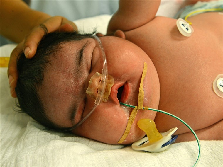 독일's heaviest newborn, baby girl Jasleen, is in the neonatal intensive care ward of the University Hospital in Leipzig, Germany.
