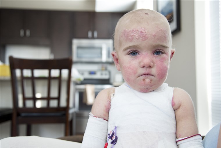 17 개월 된 Elisa McCann is living with Epidermolysis Bullosa, a rare and debilitating skin disease. Her condition has been rapidly improving after s...