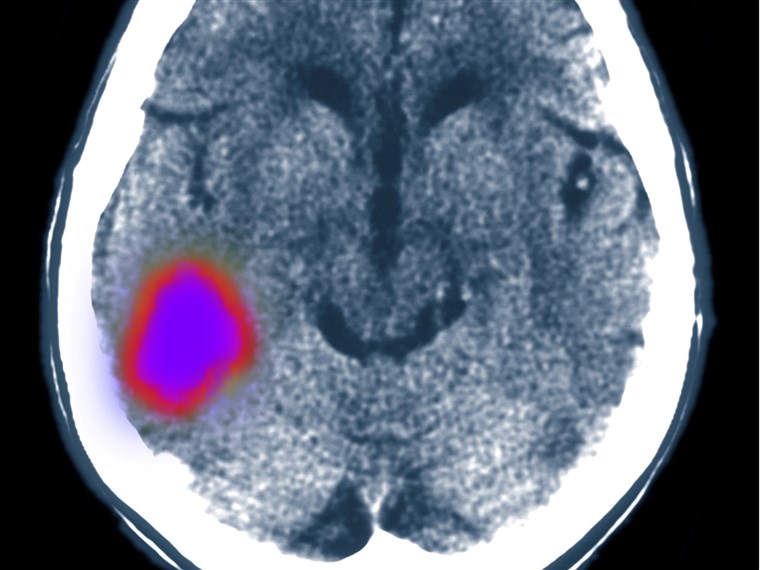 대뇌 CT scan showing stroke