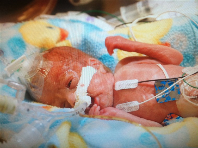トレバー needed life support when he was born at 23 weeks gestation in August 2014.