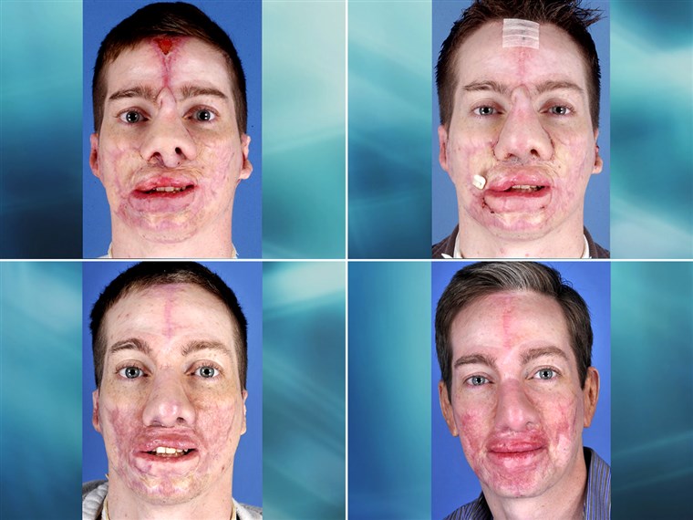 NOI. Marine corporal Aaron Mankin's face has undergone a remarkable transformation thanks to more than 60 surgeries by the surgeons in Operation Mend at UCLA Medical Center. 