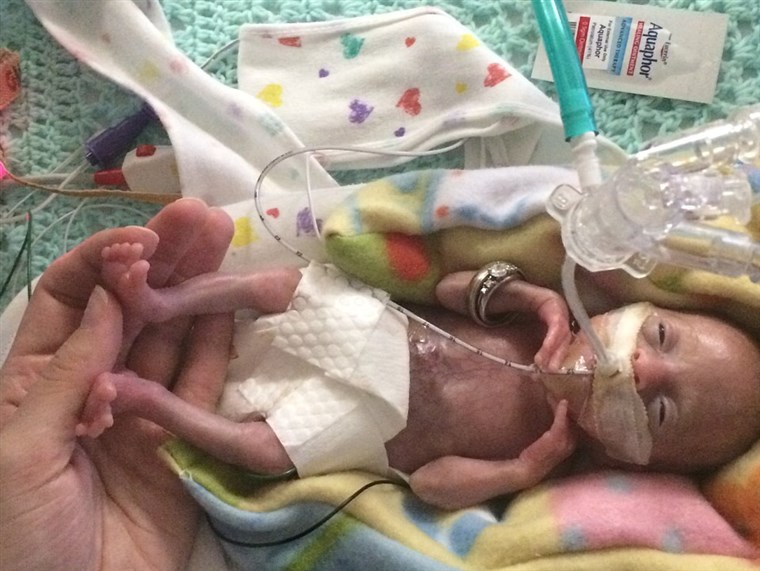 赤ちゃん Stensrud is believed to be the most premature surviving baby ever.