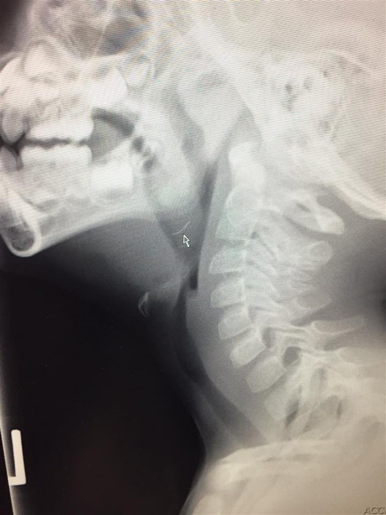 アン X-ray of 4-year-old Oliver Schenn shows the metal bristle lodged in his throat.