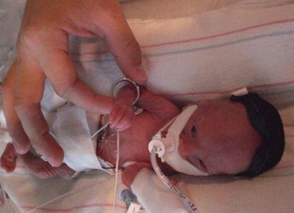 첼시 Arledge's son, Travis, was born premature at 23 weeks gestation in 2008. 