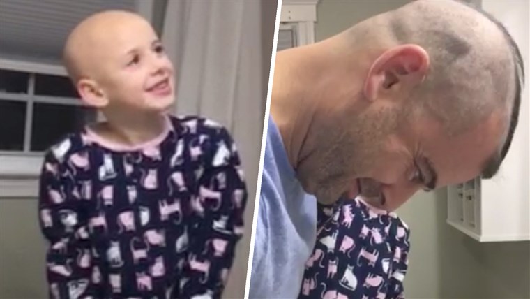 Papà Shaves Head to Cheer Up Daughter Who Lost Hair to Alopecia