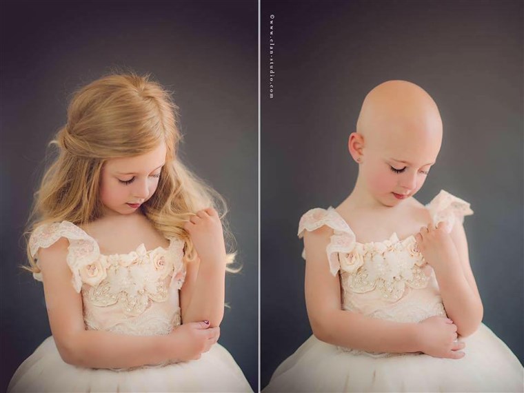 Mentre Riley was born with a full head of hair, she was completely bald by 15 months because of alopecia.