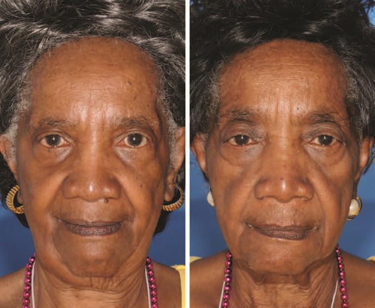 Itu twin on the left is a nonsmoker and the twin on the right smoked for 29 years. Note the differences in periorbital aging.