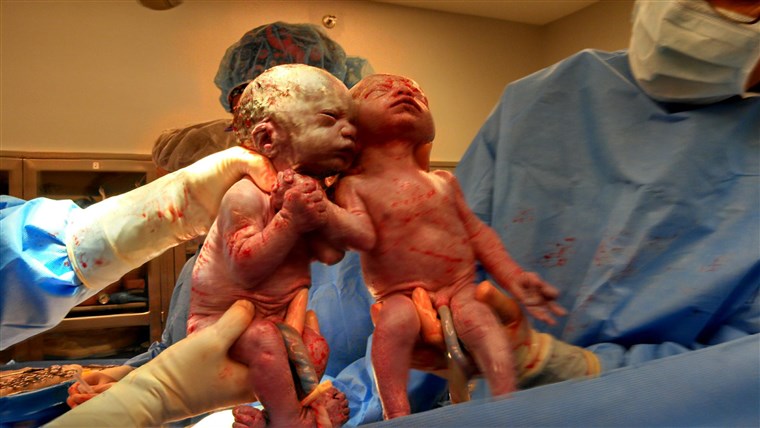 제나 and Jillian Thislethwaite, just seconds after they were born in 2014.