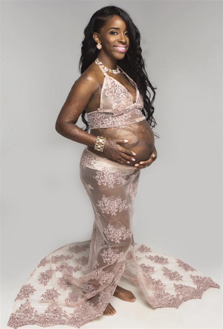 Membakar survivor's pregnancy photos go viral