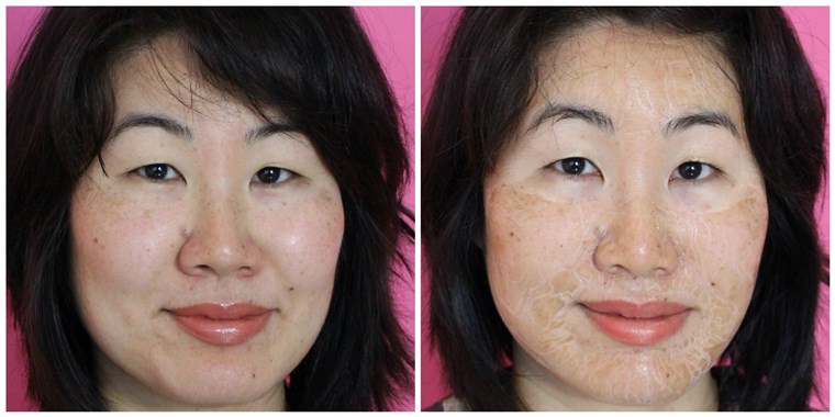 Hanacure Mask Before and After