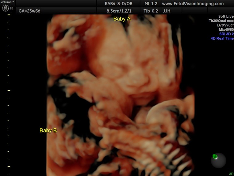 Gemelli kissing in ultrasound photo