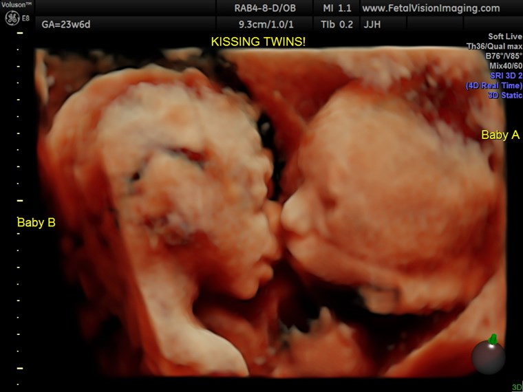 赤ちゃん twins kissing in the womb ultrasound