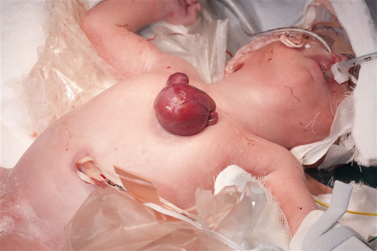 바로 after birth by emergency C-section, doctors placed Vanellope Hope in a bag to keep her heart moist prior to surgery.