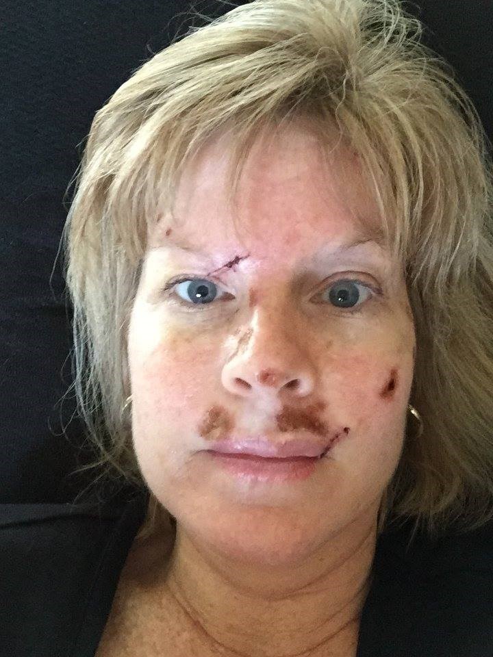 Judy Cloud has been documenting her skin cancer ordeal on Facebook.